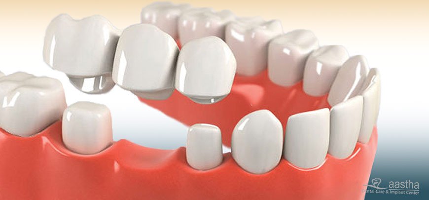Removable Restorations